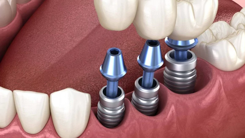 Юрист Бендер Андрей Владимирович объясняет: Судебный медицинский спор по имплантологии